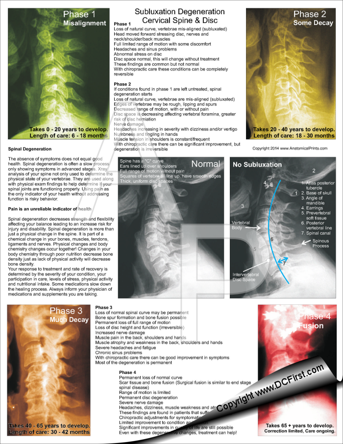 Cervical Subluxation Degeneration Pad Cervical Subluxation Degeneration Pad