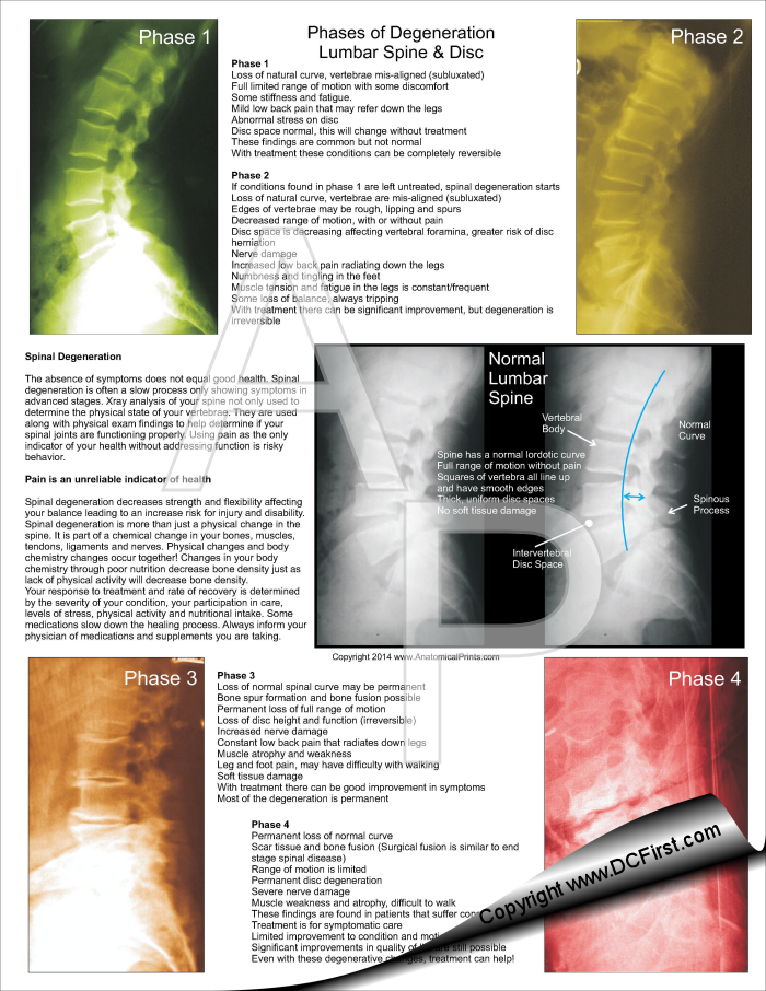 Lumbar Spinal Degeneration Tear Off Pad Lumbar Spinal Degeneration Tear Off Pad
